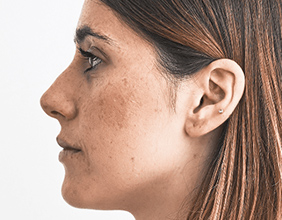 ピコトーニング(2回)