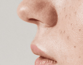 ハイドラフェイシャル